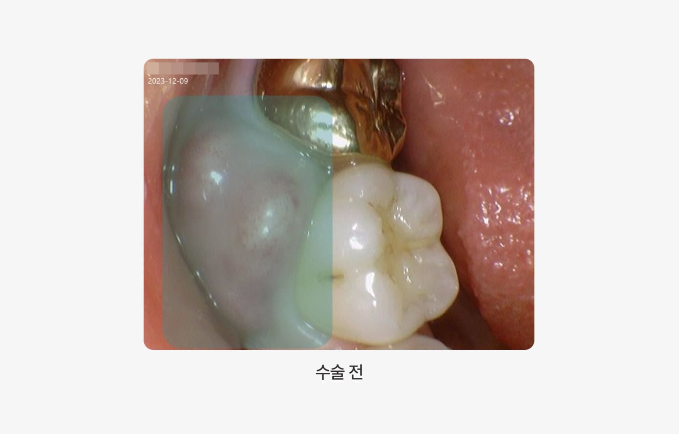 더스퀘어치과 | 잇몸 수술 전후 사진 수술 전