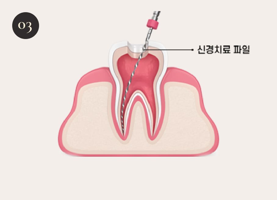 더스퀘어치과 | 더스퀘어치과 신경치료 과정