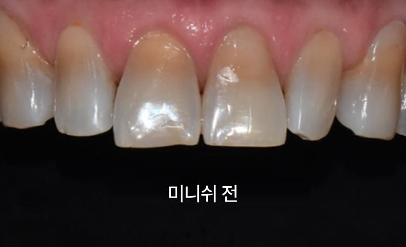 더스퀘어치과 | 이갈이 치료 방법 미니쉬 치아보존