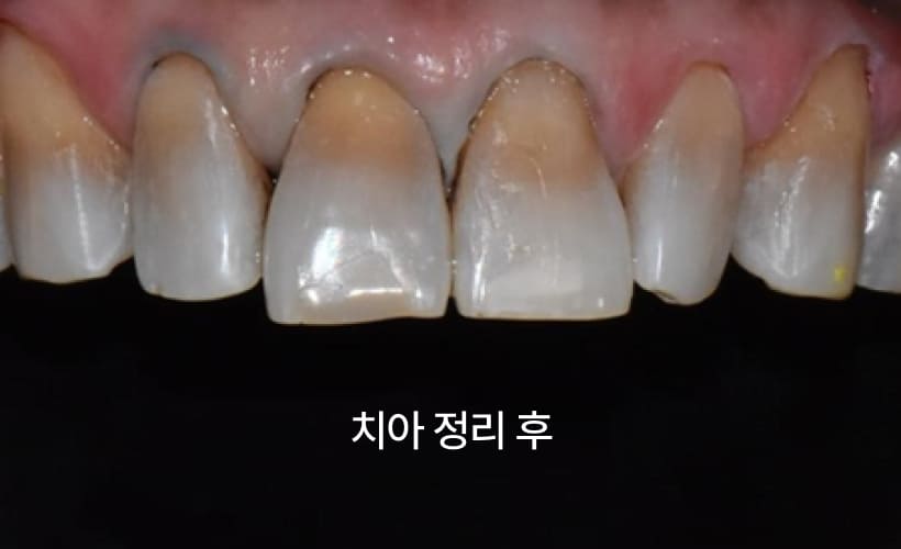 더스퀘어치과 | 이갈이 치료 방법 미니쉬 치아보존