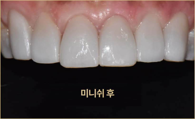 더스퀘어치과 | 이갈이 치료 방법 미니쉬 치아보존