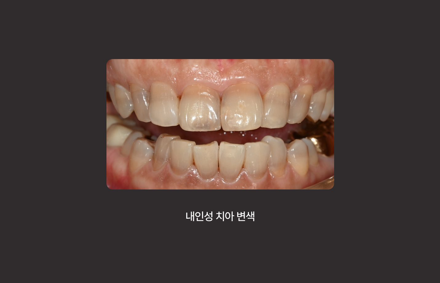 더스퀘어치과 | 치아 변색 원인 내인성
