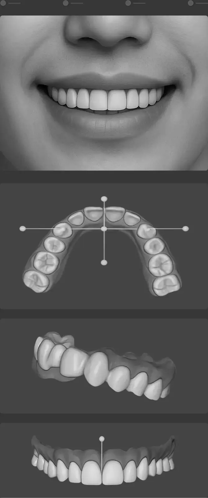더스퀘어치과 앞니치료 스마일 리허설 | 모니터로만 보던 가상 시뮬레이션