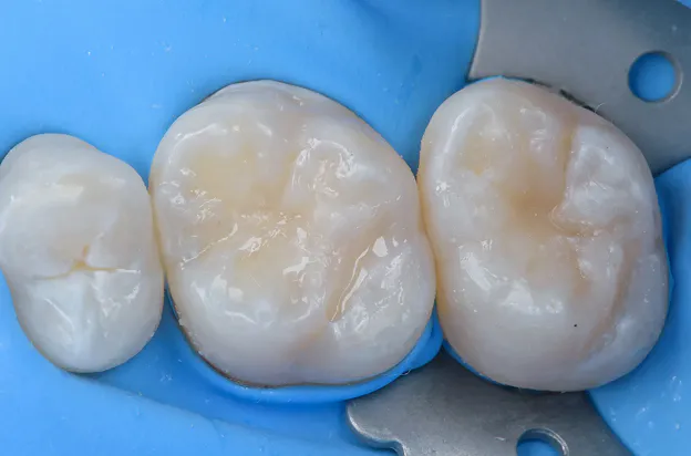 컴포짓 레진 빌드업 과정 | 레진 빌드업 Resin Build-up