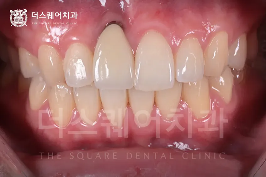 임플란트 잇몸이식이 필요한 경우 | 임플란트 보철물 심미 증진