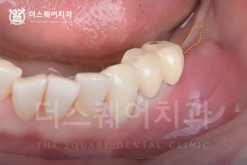 임플란트 잇몸이식이 필요한 경우 | 임플란트 주위염 방지