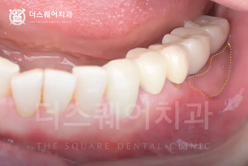 임플란트 잇몸이식이 필요한 경우 | 임플란트 주위염 방지