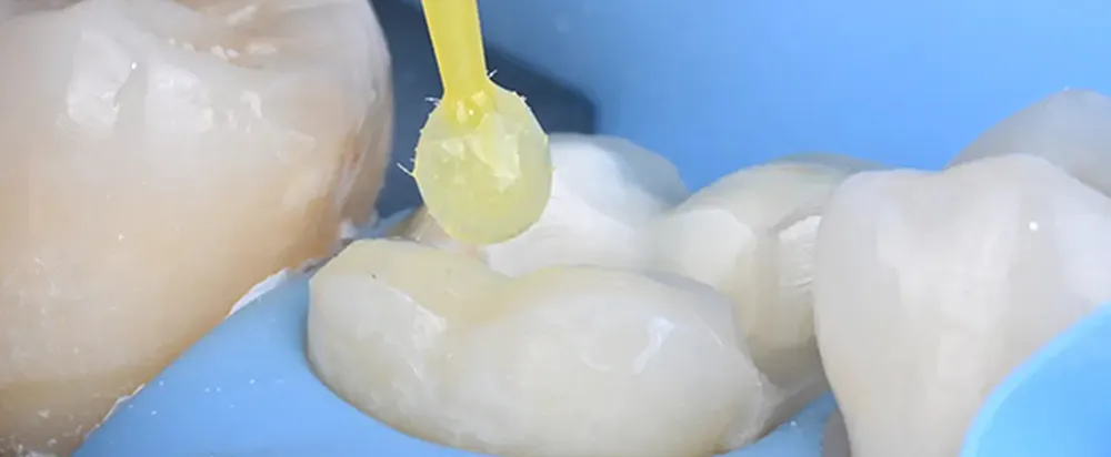 오래가는 인레이를 위한 테크닉 | 즉시 상아질 폐쇄술 Immediate Dentin Sealing, IDS