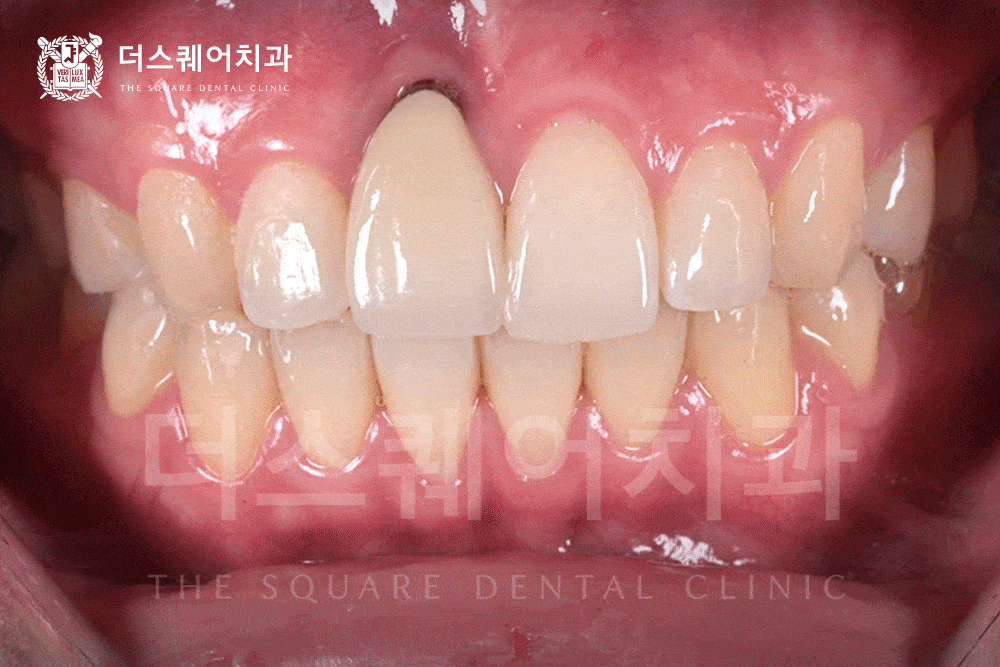 자연스럽고 오래가는 앞니 임플란트 | 임플란트 주위염 방지