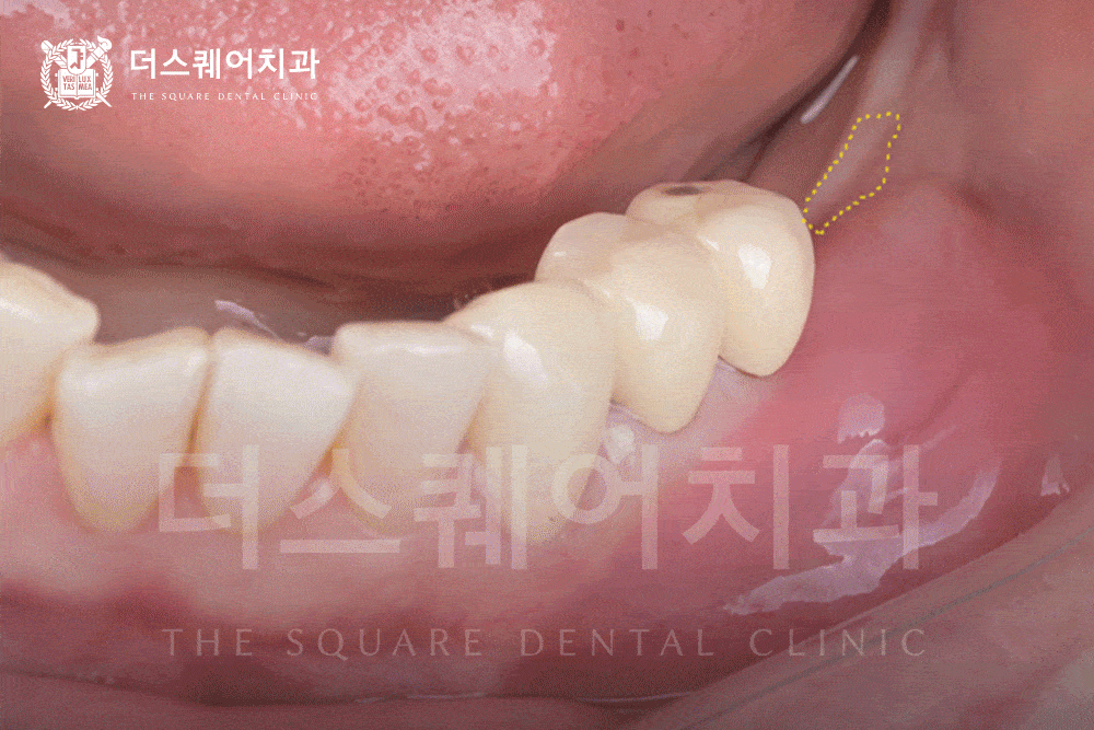 자연스럽고 오래가는 앞니 임플란트 | 임플란트 주위염 방지
