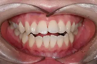 교정 사례 이미지