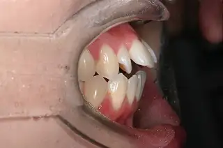 교정 사례 이미지