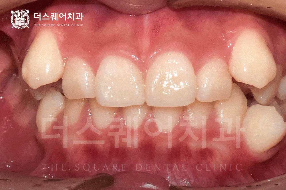 자연치아 수명을 늘려주는 진짜 교정