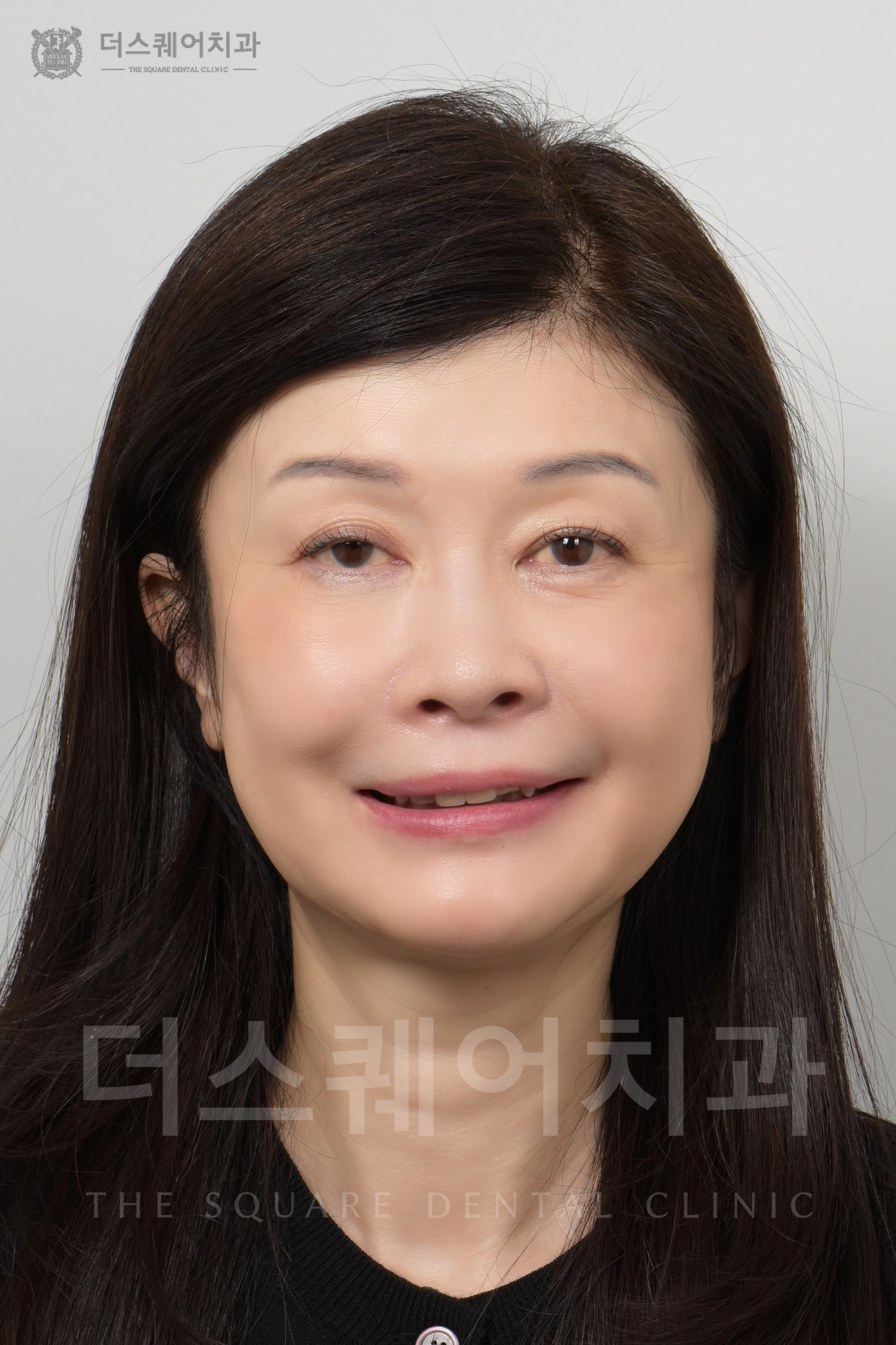 앞니 재치료, 손상, 변색, 틀어진 치아 복구를 위한 비니어큐브 심미치료 