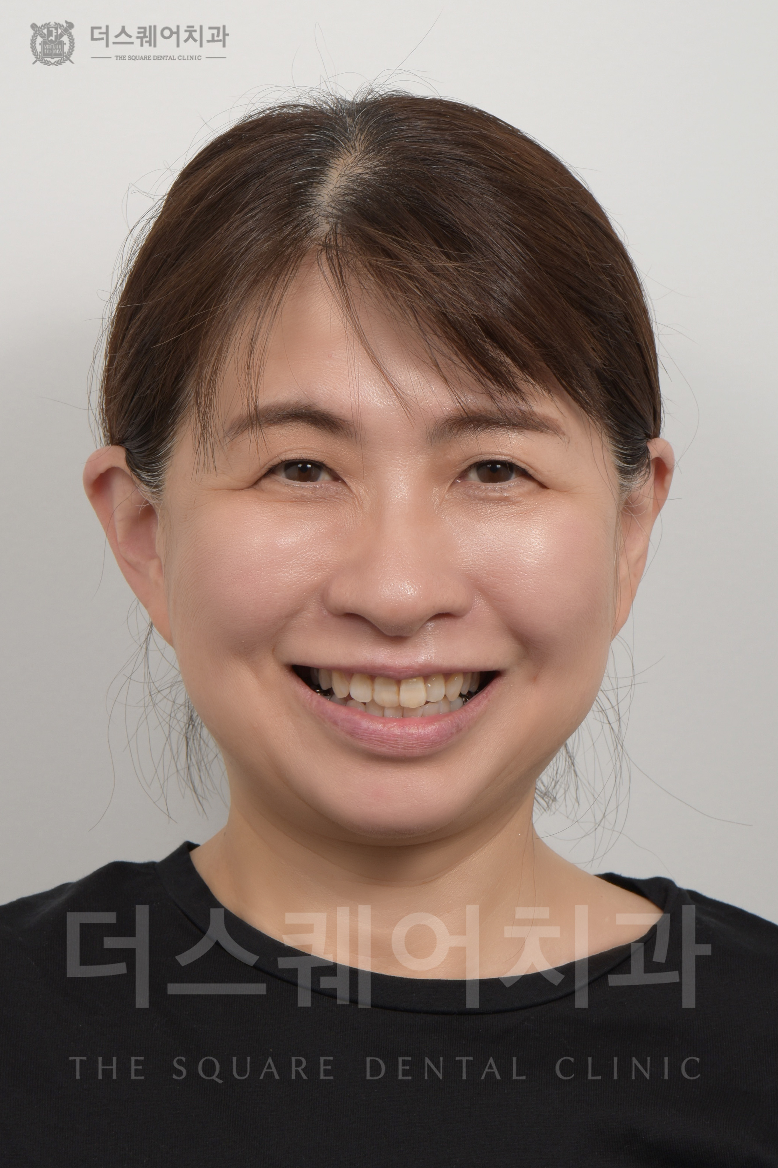 변색, 틀어진 치아 복구를 위한 비니어큐브 심미치료