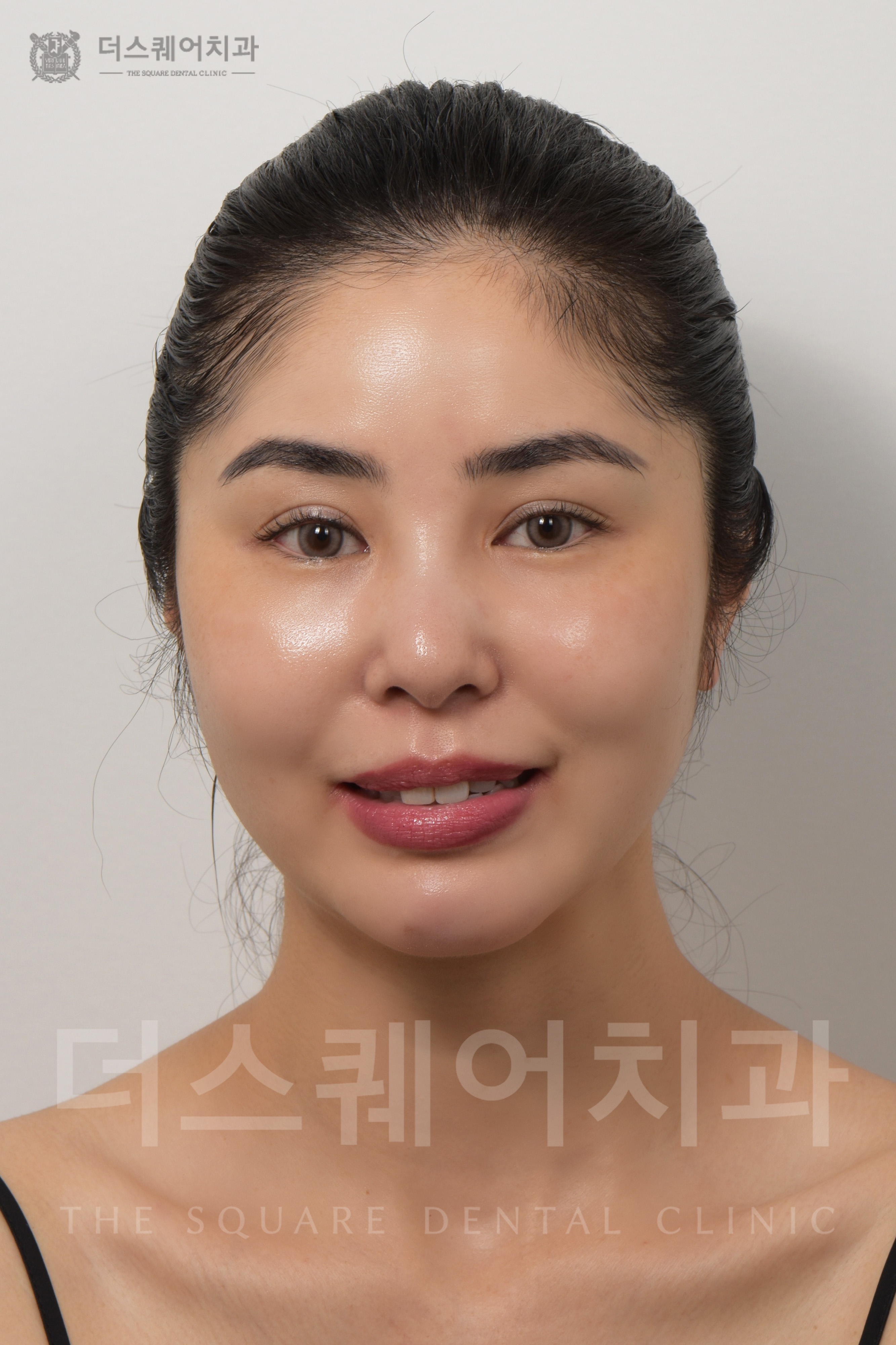 변색, 손상된 치아 복구를 위한 비니어큐브 심미치료