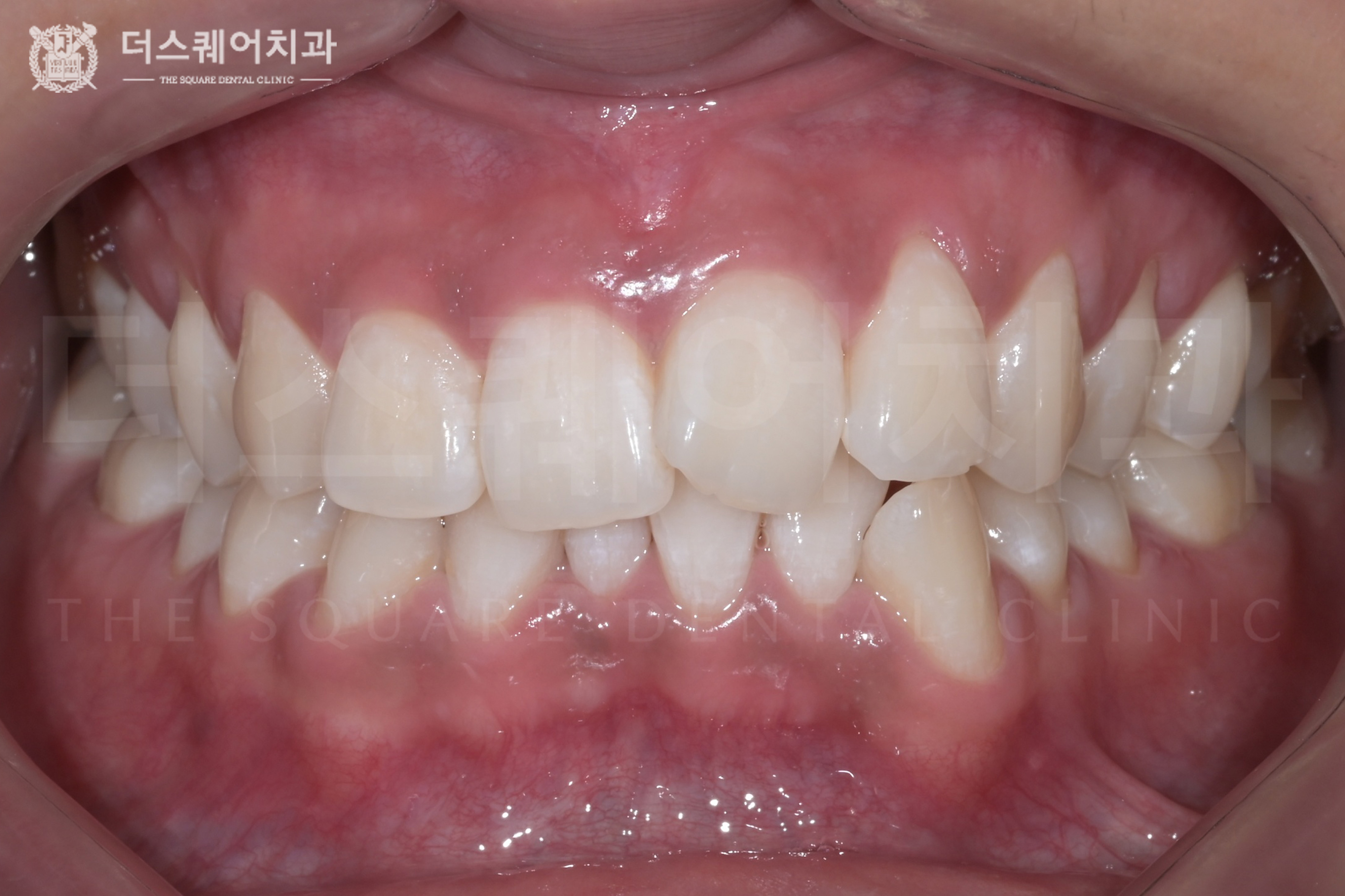 누런 치아를 밝고 환하게 개선한 치아미백