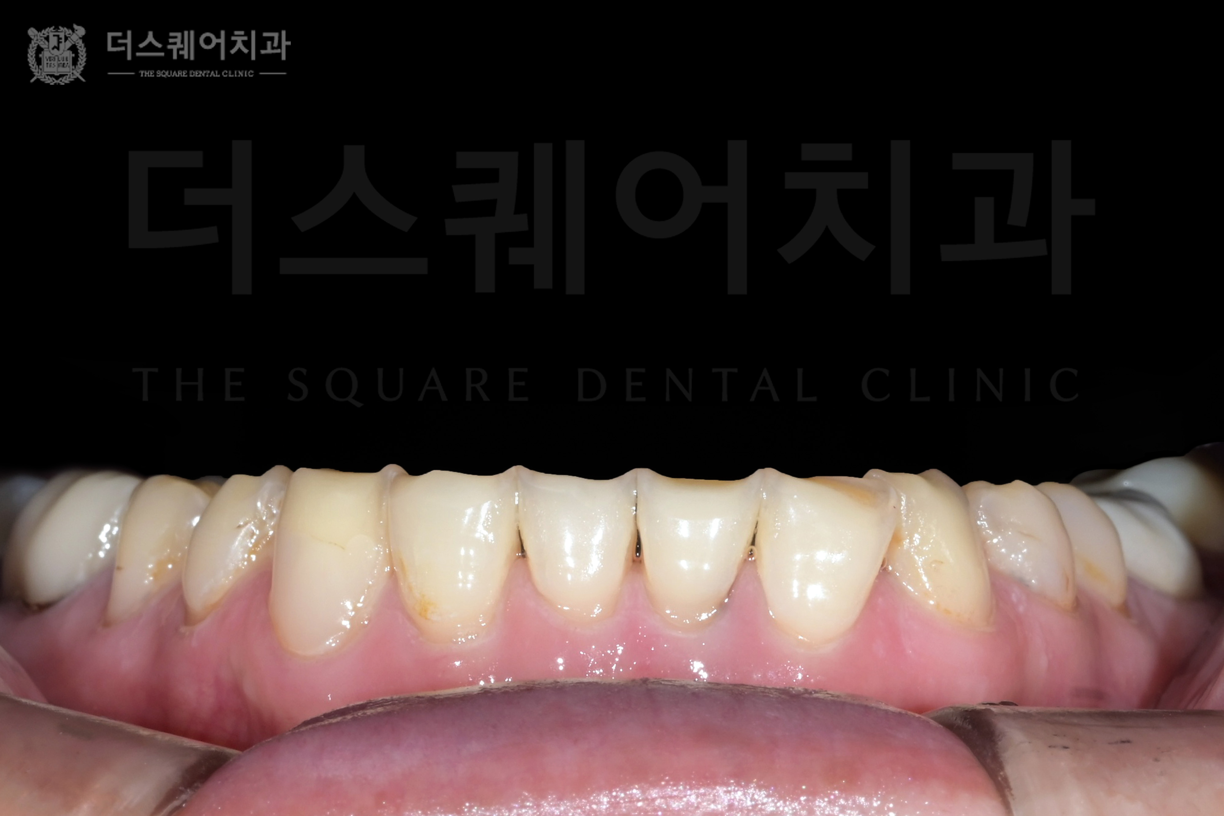 손상, 변색, 블랙 트라이앵글까지, 치아 복구를 위한 비니어큐브 심미치료