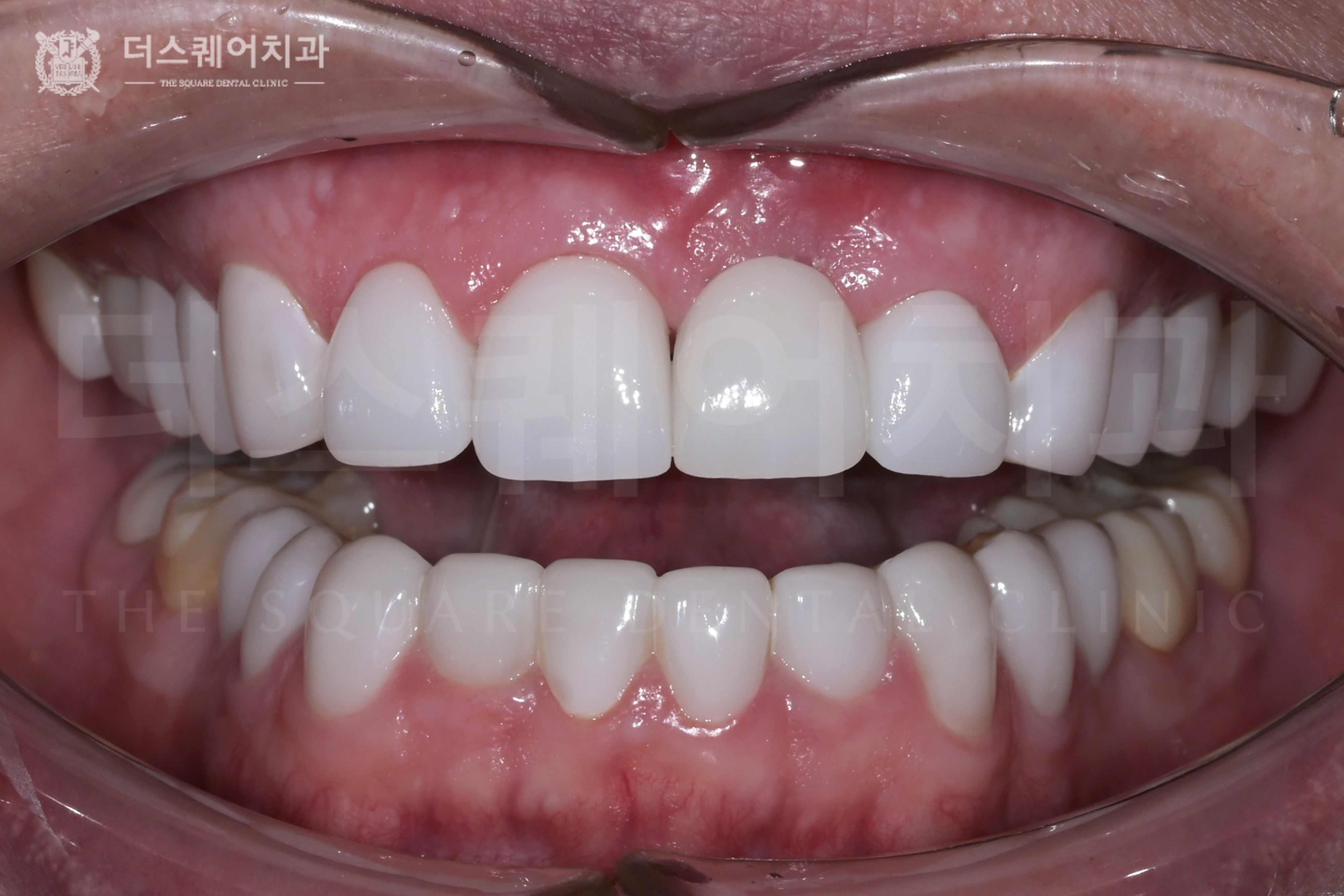 앞니 재치료, 변색된 치아 복구를 위한 미니쉬 & 앞니 임플란트 치료