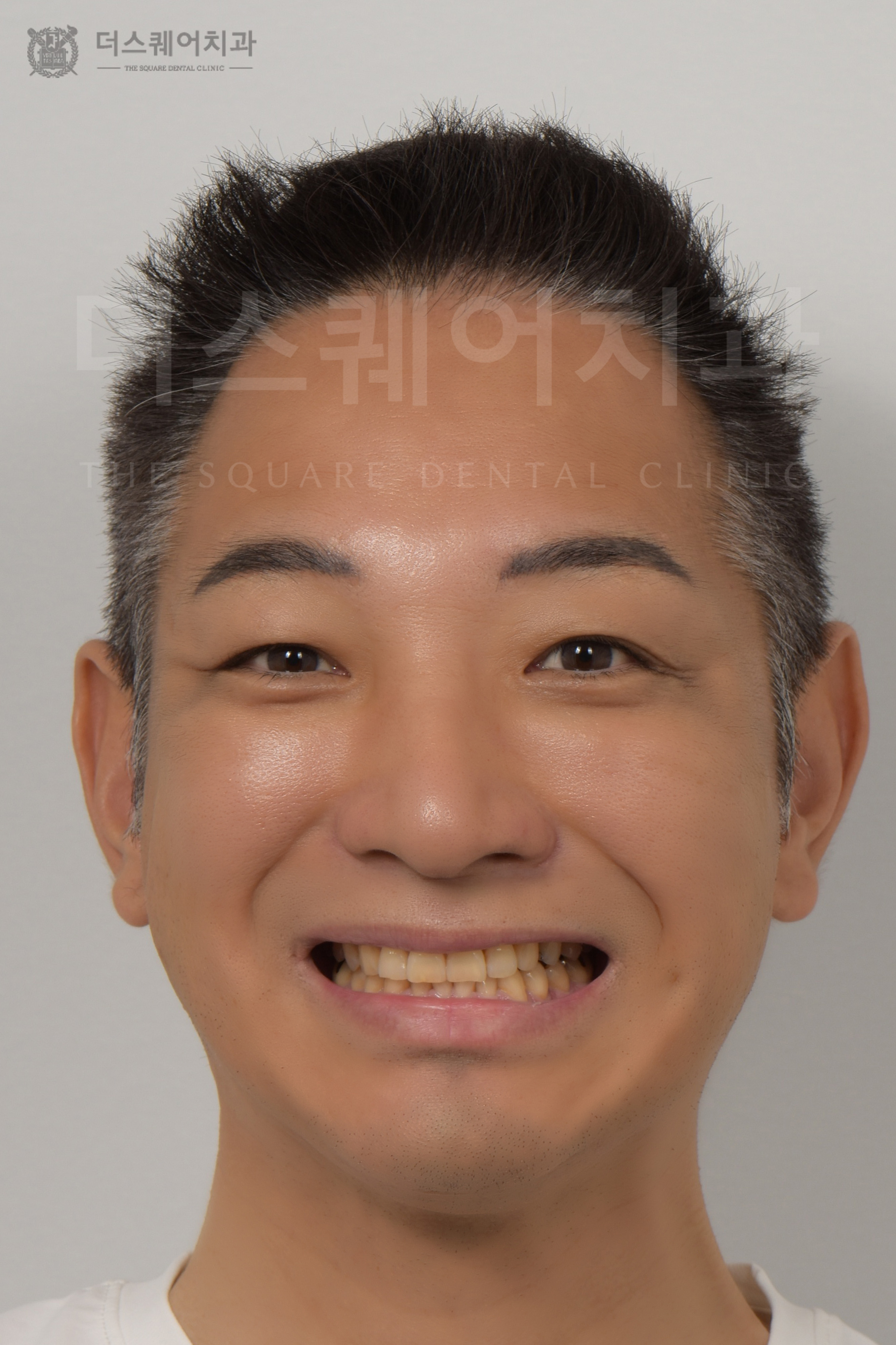 손상,변색,틀어진 치아 복구를 위한 비니어큐브 심미치료
