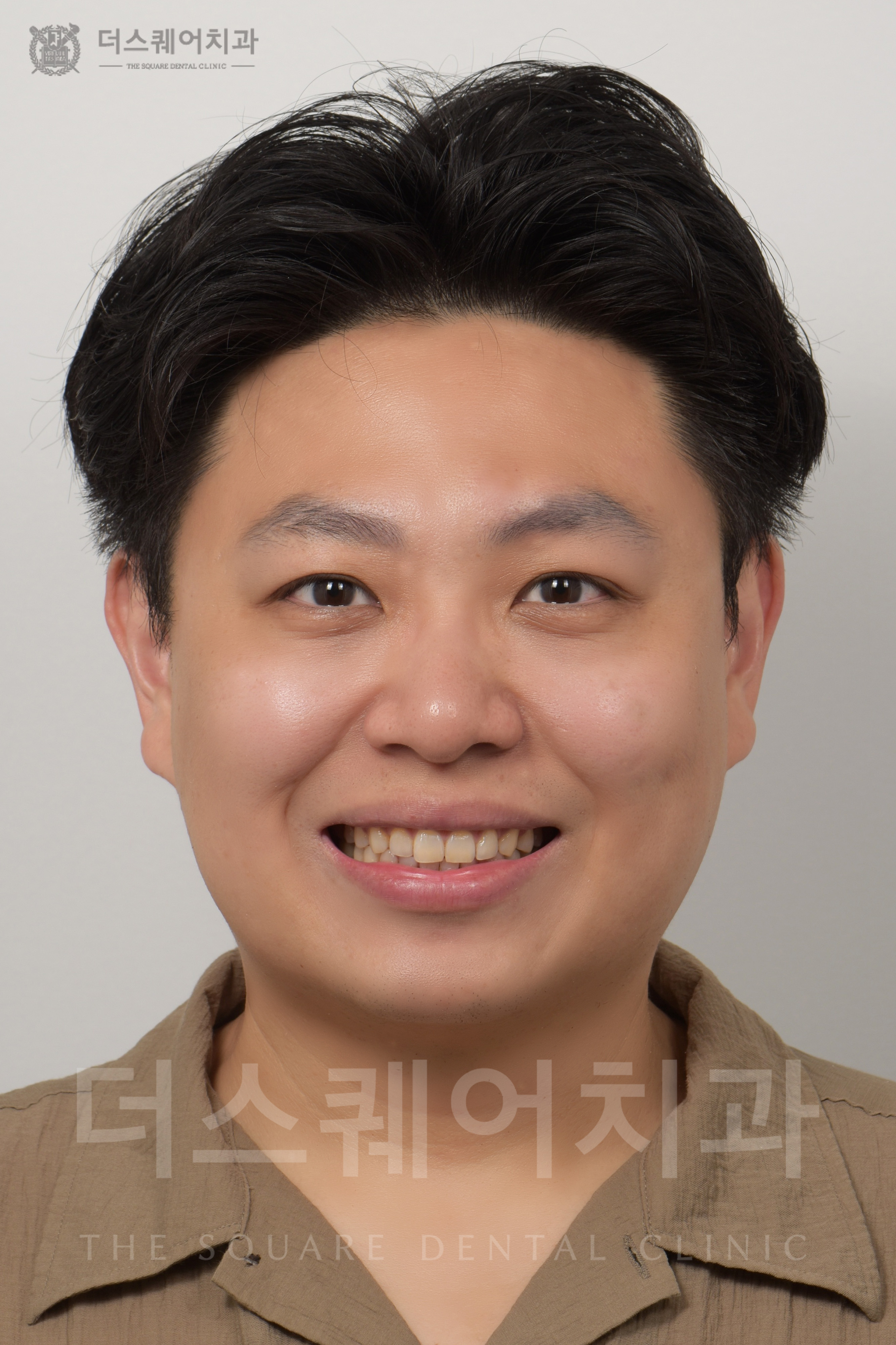 변색, 손상된 치아 복구를 위한 비니어큐브 심미치료