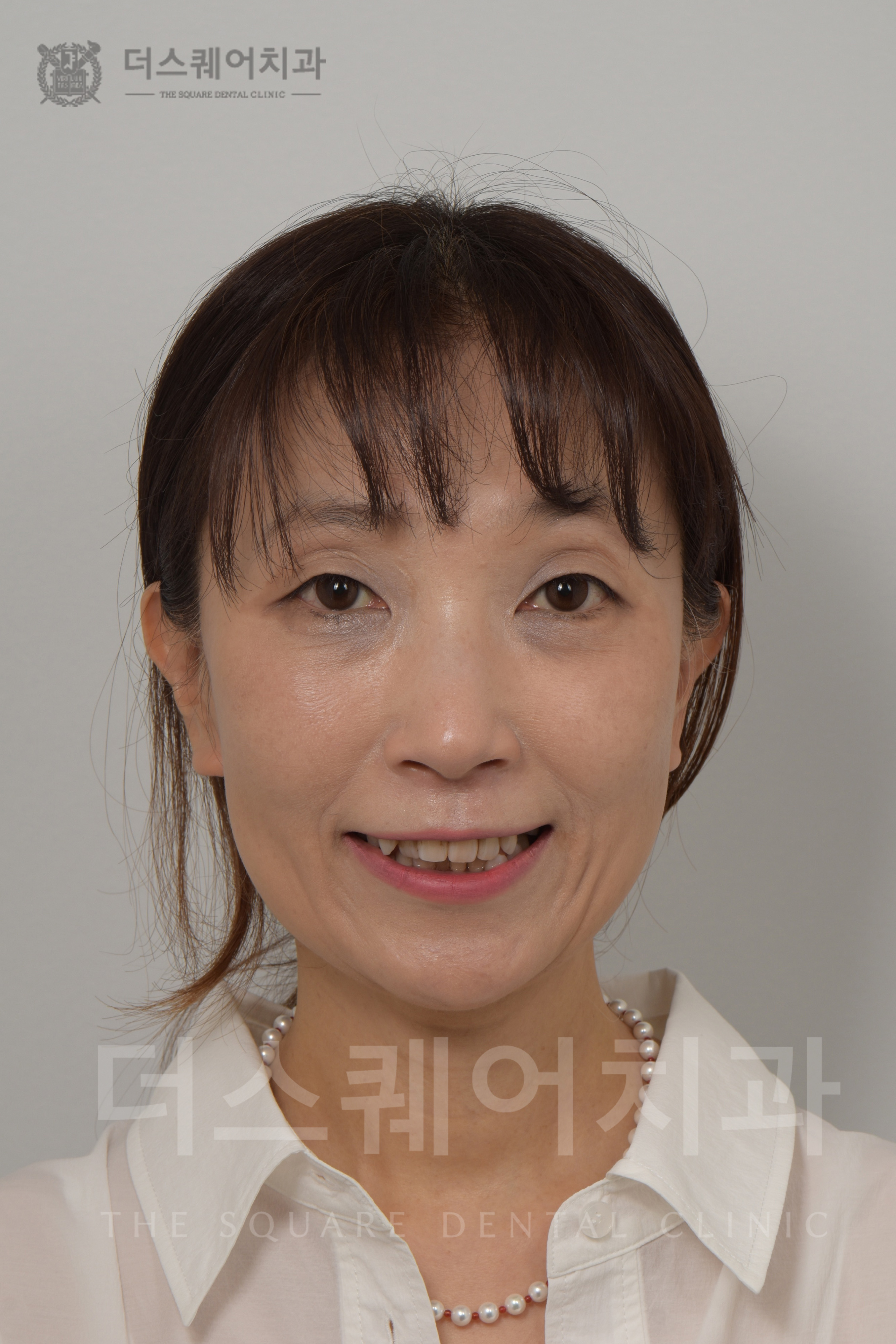 틀어진 치아, 부정교합, 변색, 파손된 치아 복구를 위한 미니쉬 심미치료