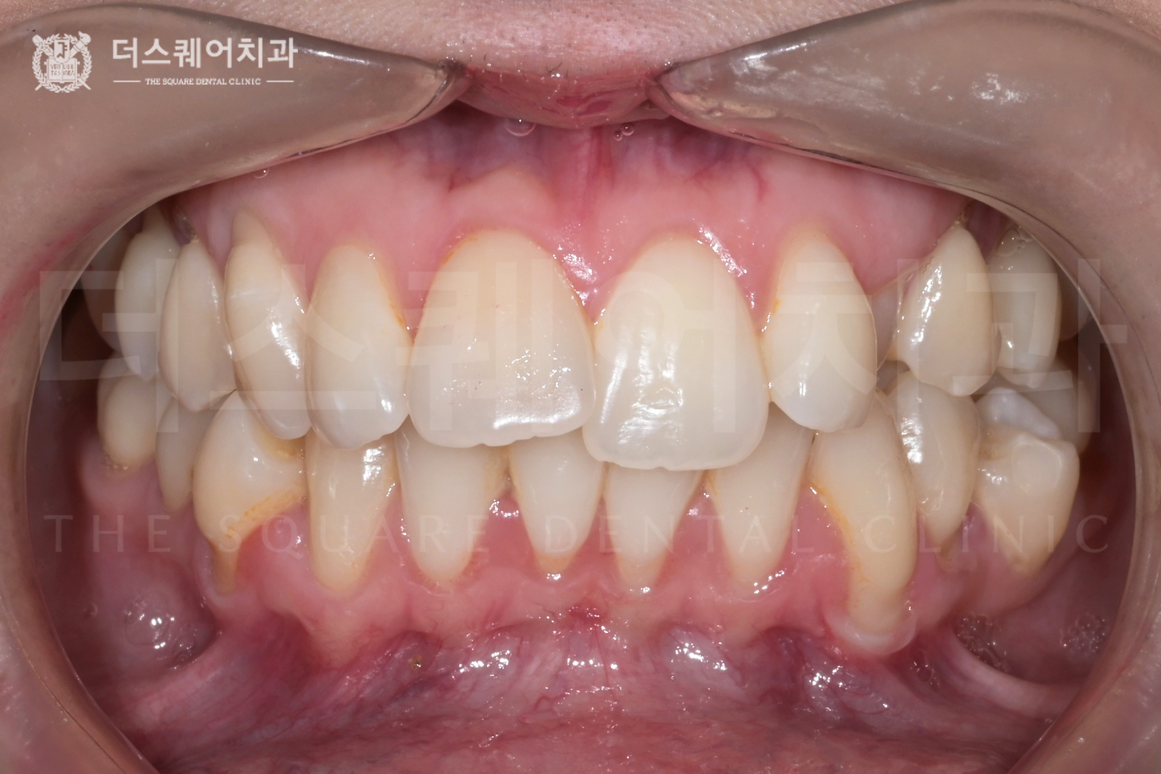 변색된 치아를 위한 전문가 치아미백