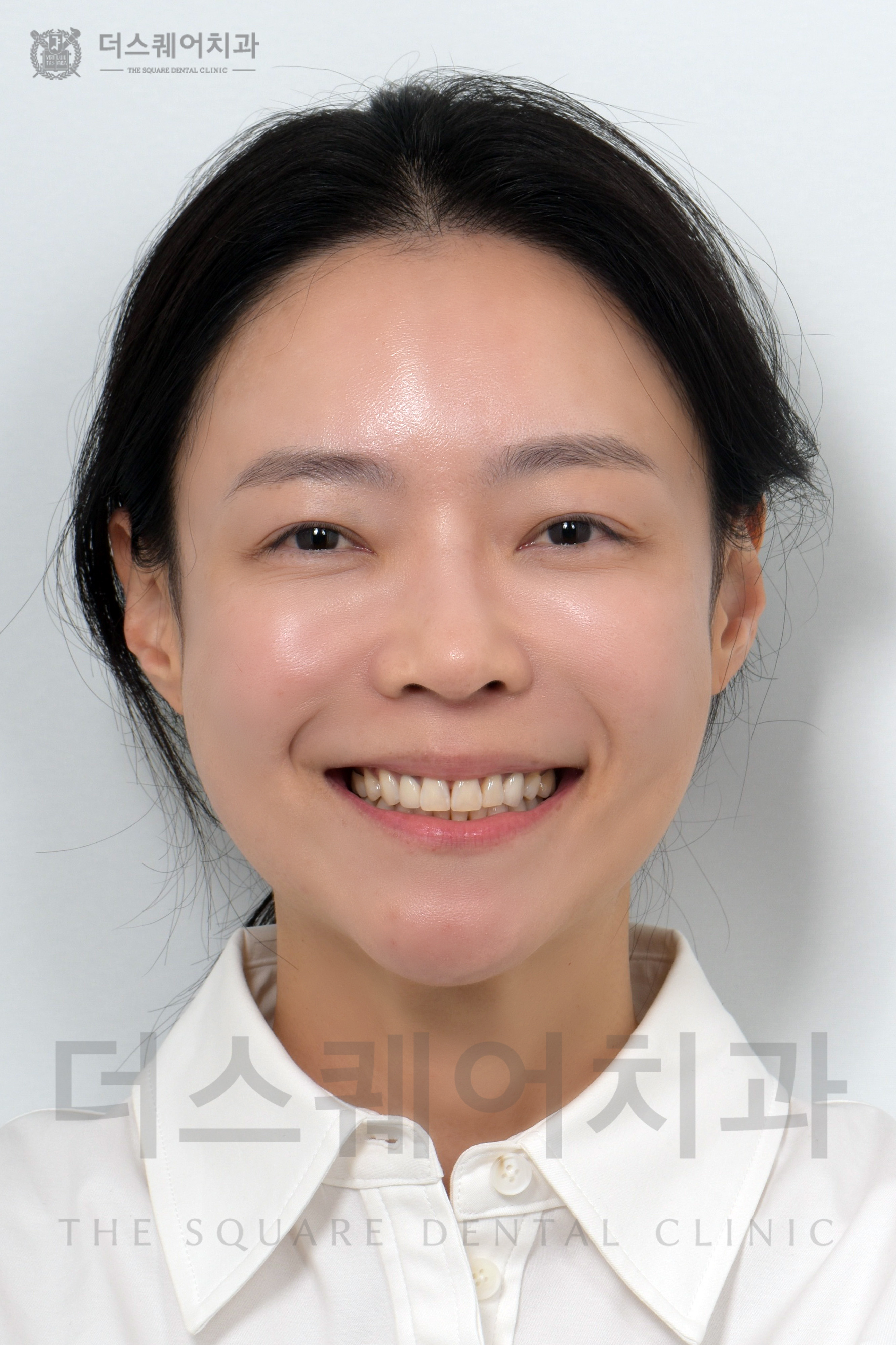 앞니 재치료, 변색, 손상된 치아 복구를 위한 미니쉬 심미치료